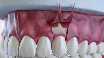 Subepithelial Connective Tissue Grafting