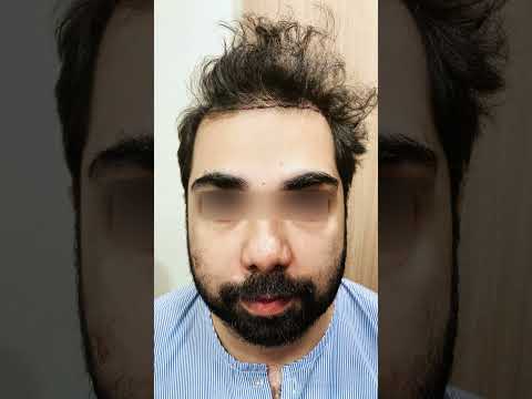 Hair transplant transformation video 1