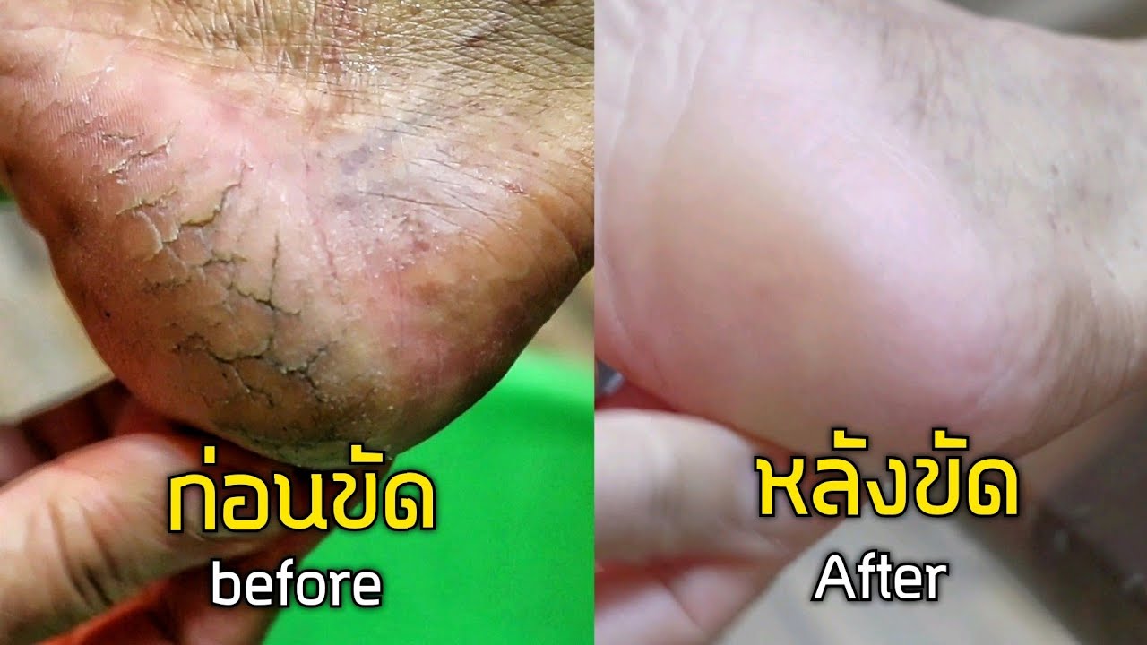 ส้นเท้าแตกขนาดนี้ ทรมานสุดๆ [ขัดส้นเท้า] @บางกะปิ