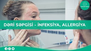 Rəvan Saat - Dəri Səpgisi - Infeksiya Allergiya