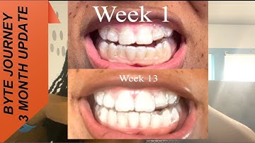 BYTE ALIGNERS: 3 MONTH UPDATE | Ben and Cin