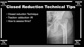 Closed reductions for intertrochanteric femur fractures