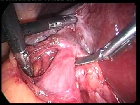 Laparoscopic Videos (edited-6)- Lap Chole In Cholecystoenteric Fistula-1