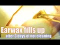 Earwax fills up after 3 days of not cleaning | earwax ASMR | cleaning ears in real person