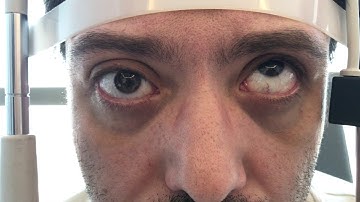 Right Chronic Oculomotor Nerve Palsy With Aberrant Regeneration