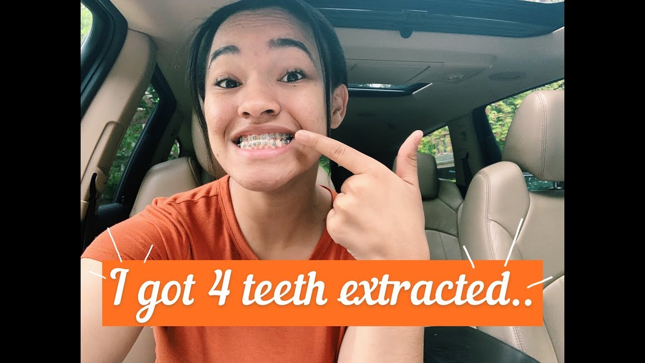 I got 4 teeth extracted... BRACES UPDATE YouTube
