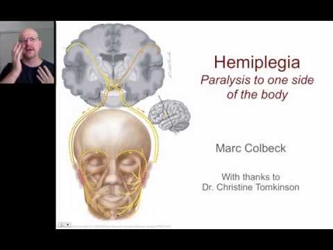 Video: Hemiplegia - Glosarium Istilah Medis