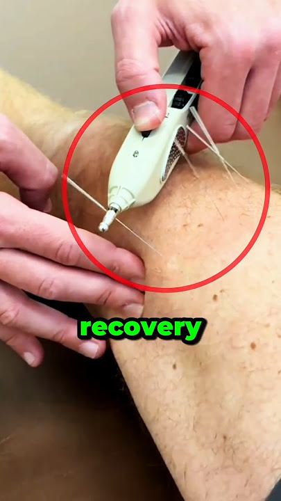This Is How Pros Handle Muscle Tension (@rehabnrun/@madis_dillenburg )