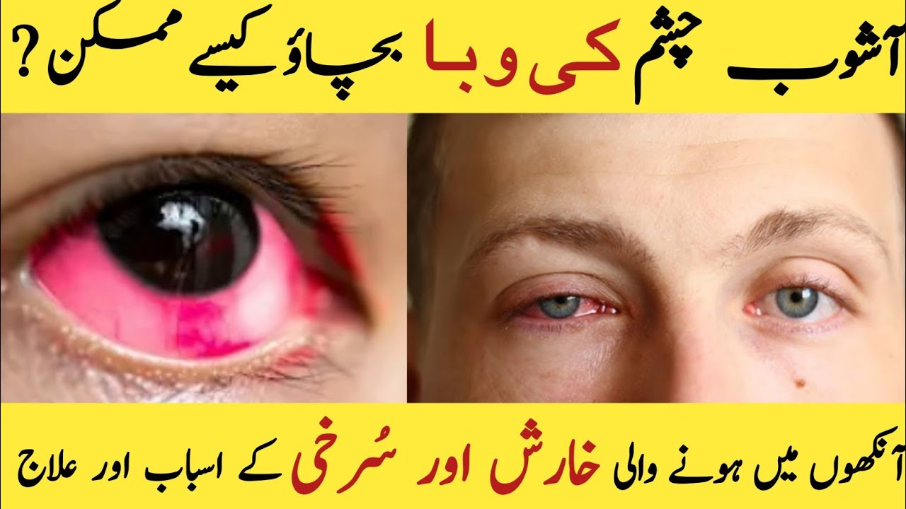 eyes infection in pakistaneye infection eye infection home remedies