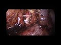 Rt laparoscopic radical nephrectomy for kidney cancerdr rajesh ranjan urologistlap surgeon