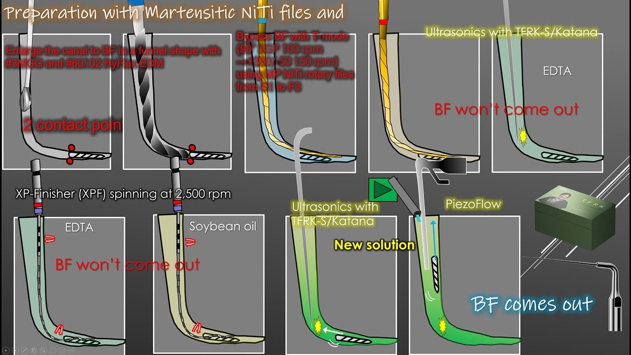 New solution used with ultrasonics to remove broken files/新たな超音波破折器具除去用の媒体