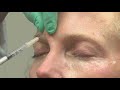 Botox results alter while on GLP-1 weight-loss drugs, study says