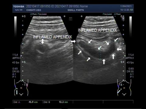 Inflamed Appendix, Localization by Ultrasound.