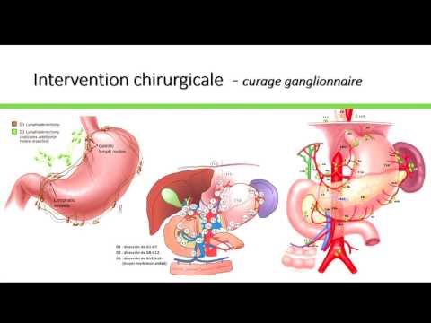 Vidéo: Gastrectomie - Glossaire Des Termes Médicaux