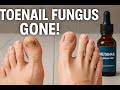 Fix Your Toenail Fungus with Metanail Serum Pro