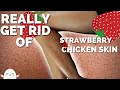 HOW TO GET RID OF STRAWBERRY LEGS | No More Bumpy Skin, Keratosis Pilaris, or Chicken Skin