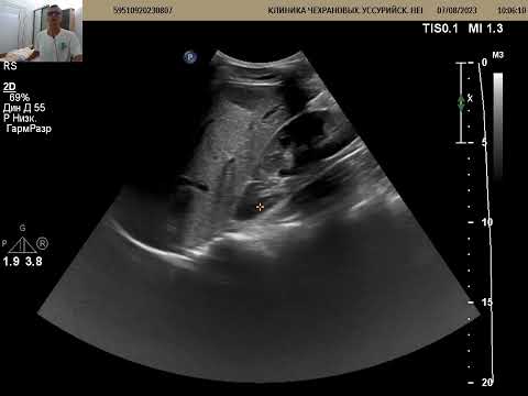 УЗИ органов брюшной полости. 19 лет, девушка, есть новообразование печени.