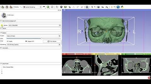 STL 3D orbital wall reconstruction from DICOM 2D CT scan with Slicer 4.9.0