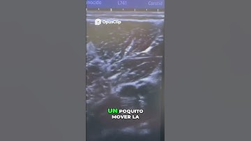 ATRAPAMIENTO DEL NERVIO TIBIAL EN LS ARCADA DEL SOLEO💥 - Vídeo Completo en YouTube #fisioterapia