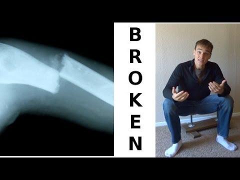 Why Vegans Develop Weak, Breakable Bones