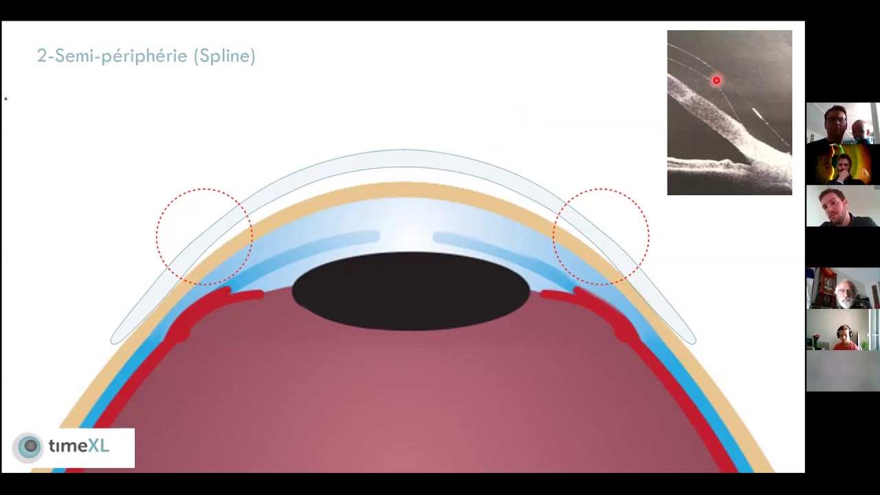 TimeXL BT : lentille sclérale bitangentielle