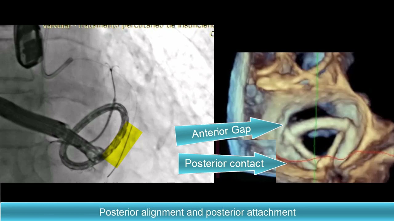 Heart valve surgery - UF Health