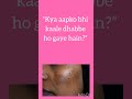 Face Pimples Problem | Acne Causes, Treatment &amp; Tips #doctor #nursing #pharmcist #antibiotic