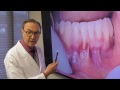 Beautiful Treatment for Gum Recession Case Michigan