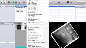 How to anonymise cases in OsiriX for teaching purposes
