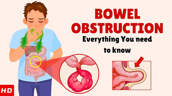 Bowel Obstruction – Causes, Signs and Symptoms, Diagnosis & Treatment