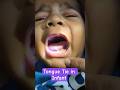 Feeding Difficulties? It Could Be Tongue Tie.Dr Vivekanand #reels #viralvideo #shortsfeed #video