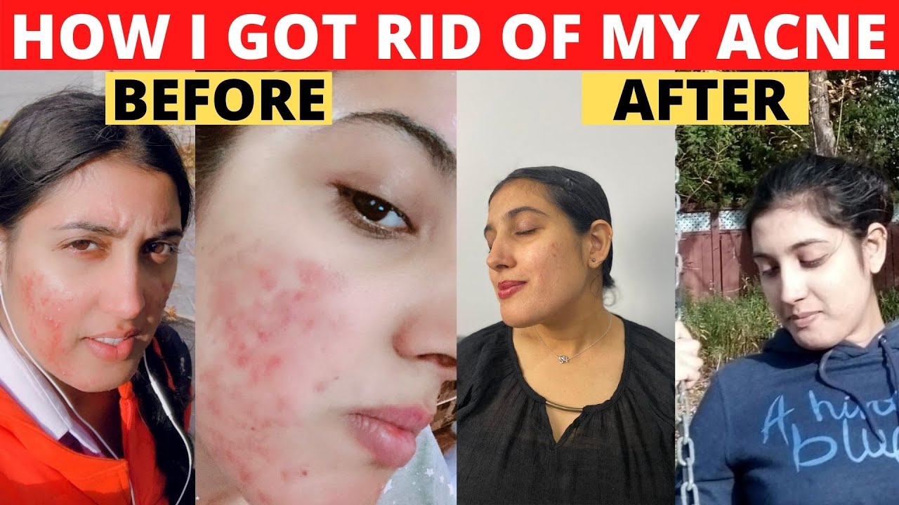 My Acne Story | How I got rid of my ACNE | Pimples को कैसे रोके | How I ...