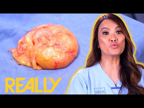 Dr. Lee Removes A Lipoma In Less Than 10 Minutes! | Dr. Pimple Popper: Pop Ups