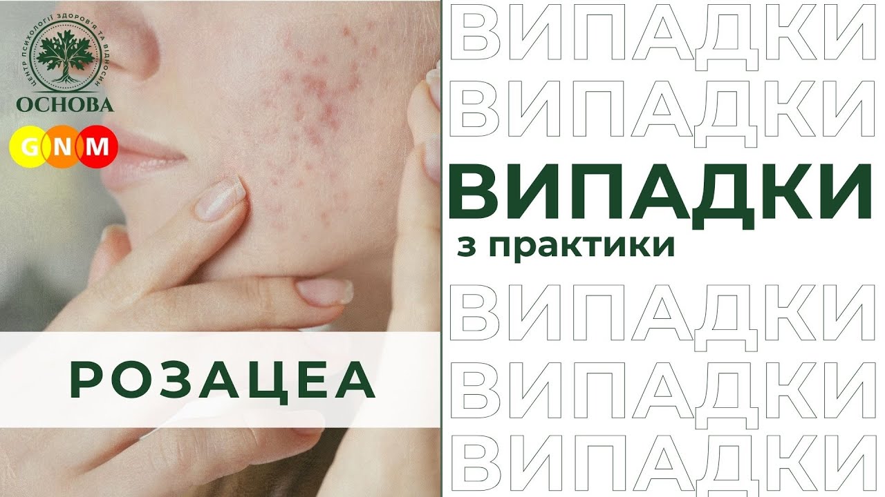 Германська Нова Медицина. Розацея на обличчі - YouTube