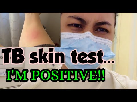 Life in Canada: Nagpositive ako sa TB skin test...