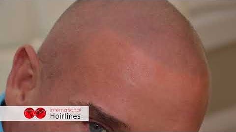 International Hairlines Scalp Micropigmentation
