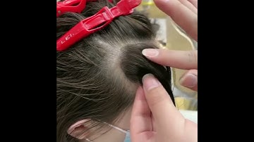 Thumbnail of INVISIBLE Cover-up Hair Patches! PERFECT for hair-loss women!
