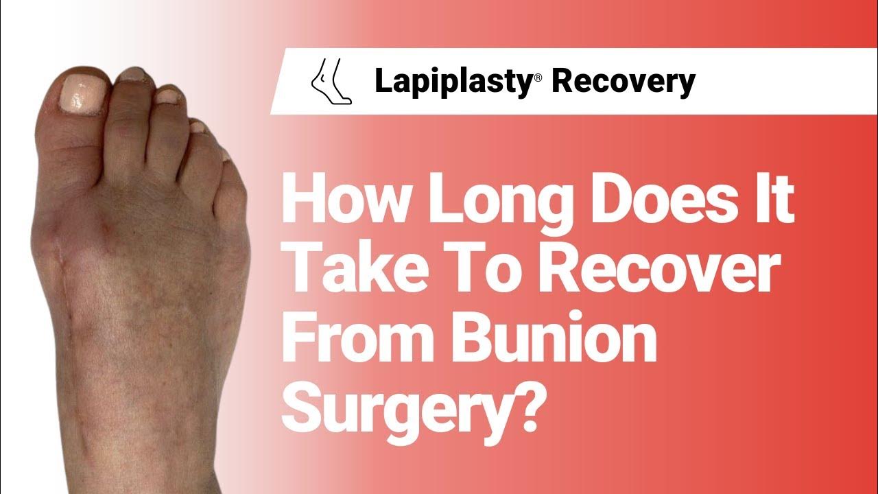 How Long Does It Take To Recover From Bunion Surgery What To Expect how-long-does-it-take-to-recover-from-bunion-surgery-what-to-expect