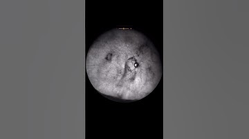 Vitreous Opacities | Eye Floaters #shorts