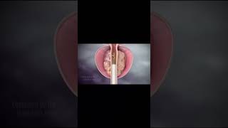 Prostatitis (Prostate Inflammation): Different Types, Causes, Signs & Symptoms, Diagnosis