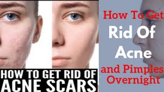 How to get rid of Acne scars, Fade Pimple marks & Pigmentation Solution | How to get Clear Skin