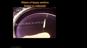 GI Stromal Tumors: A Pathologist