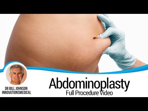 Awake Tummy Tuck - Abdominoplasty - Full Procedure Video - Belly Fat