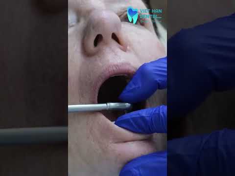 Lắp răng Implant toàn hàm All-on-4 khôi phục hàm răng đã mất cho khách hàng