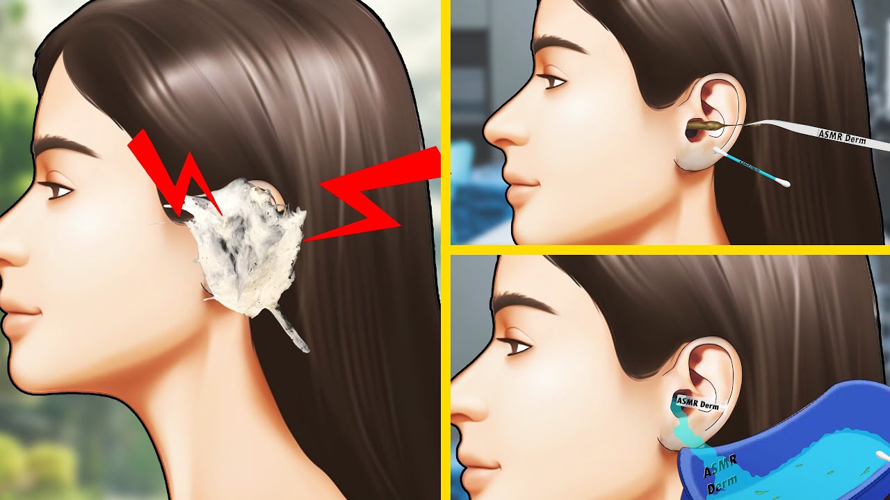 ASMR Ear wax removal ASMR Animation EARWAX Removal SATISFYING