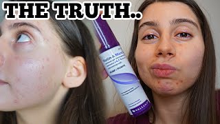 What I REALLY think of Tretinoin... 2 month update.