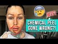 CHEMICAL PEEL GONE WRONG?! Where have I been? | KristenLeanneStyle
