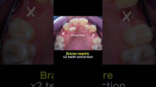 Braces for crowded teeth, require extraction #braces #orthodontist #dentist #teeth #orthodontics