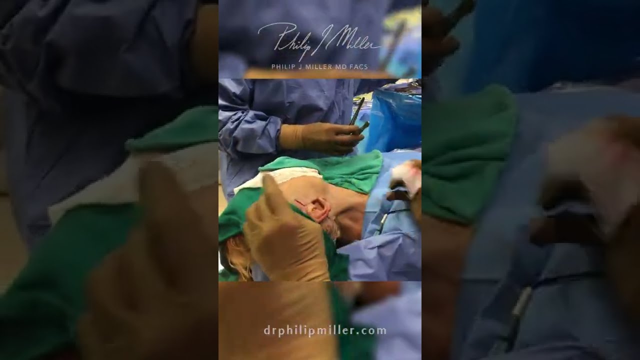 Dr. Miller Explains The Importance Of Doing SMAS Facelift | Why You Don’t Want Skin-Only Facelift