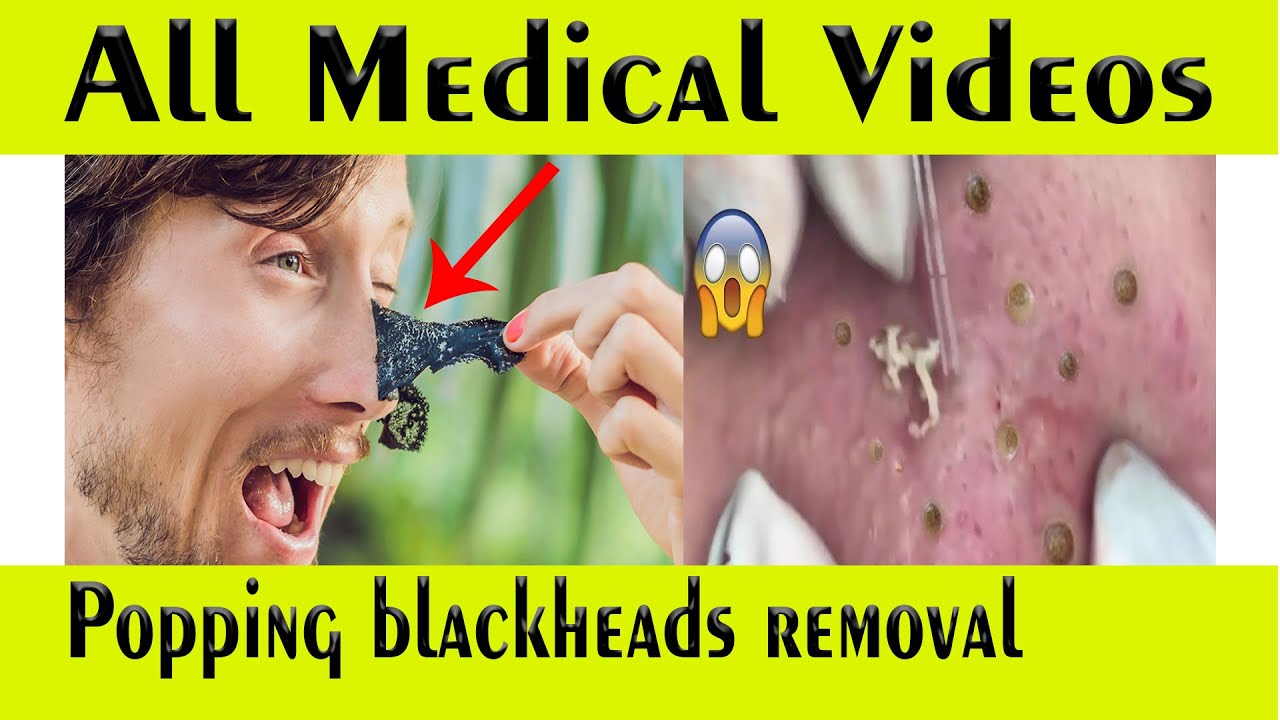 Popping blackheads Removal Popping Blackheads treatment extraction